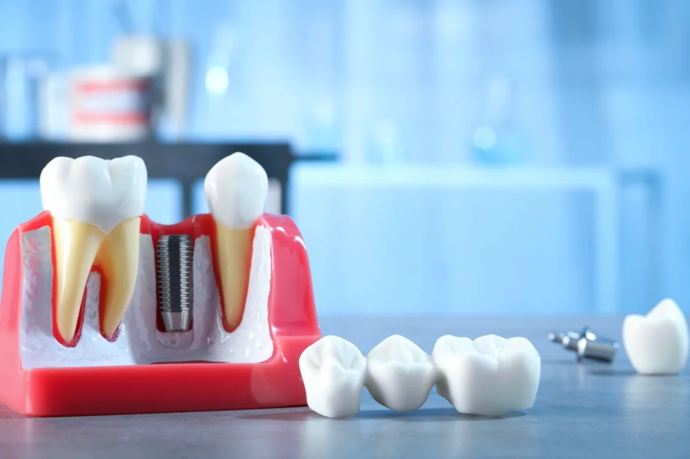 Dental model displaying a bridge, crown, and implant components